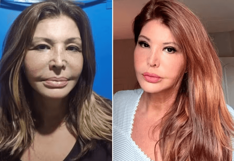 Roberta Close recorre à harmonização facial aos 60 anos.