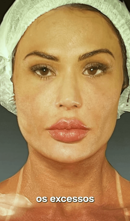 Gracyanne Barbosa abandona preenchimentos faciais e investe em tecnologia adotada por Kim Kardashian