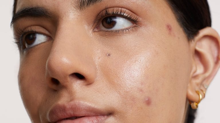 Acne afeta 1 em cada 4 brasileiros e impacta vida pessoal e profissional, aponta estudo internacional